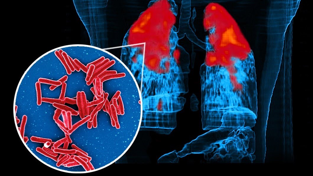 TB bacteria's tough armor: A cellular shield against treatment